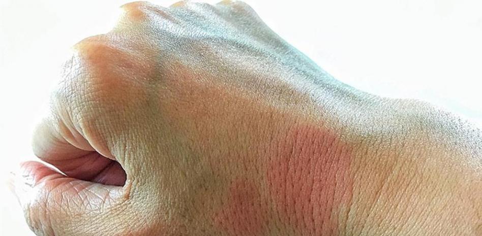 Lupus: síntomas y tratamiento de esta silenciosa enfermedad autoinmune