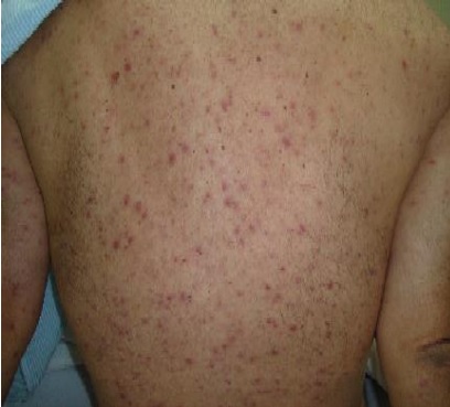 Seremi de Salud informa aumento de casos de tifus de los matorrales en la región